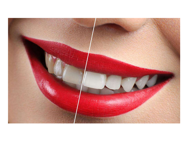 牙齒美白的方式很多，但靠譜的方法就這幾種